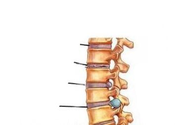 Keturi osteochondrozės raidos etapai